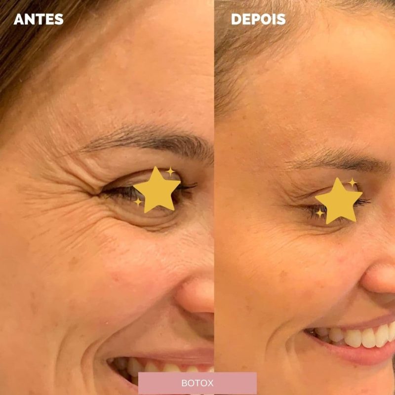 Antes e depois de botox aplicado na área dos olhos