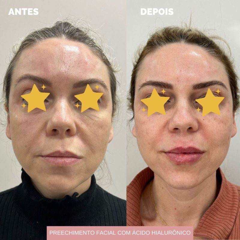 Antes e depois preenchimento facial - ácido hialurônico